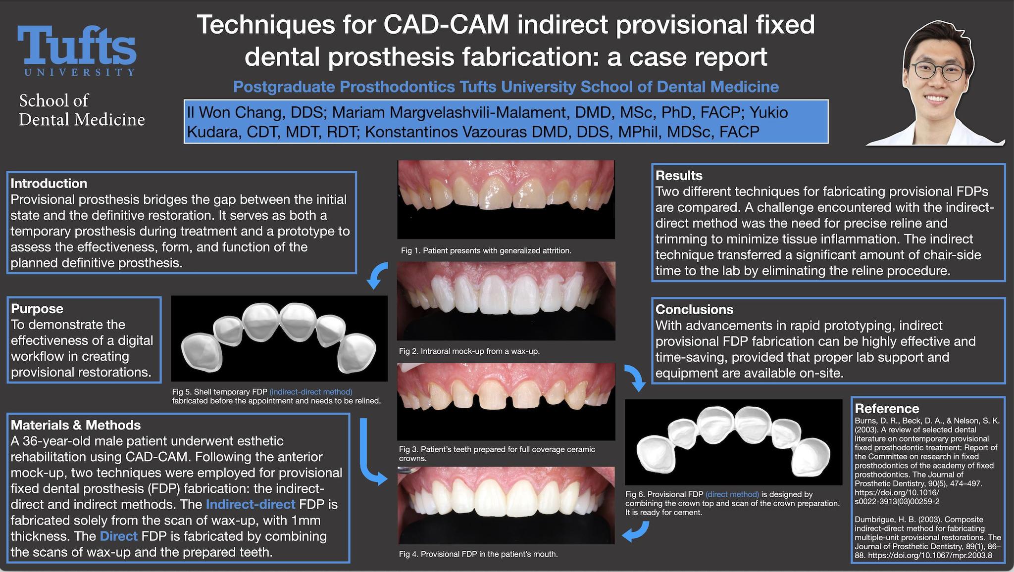 25. Technique for CAD-CAM indirect provisional fixed partial denture ...