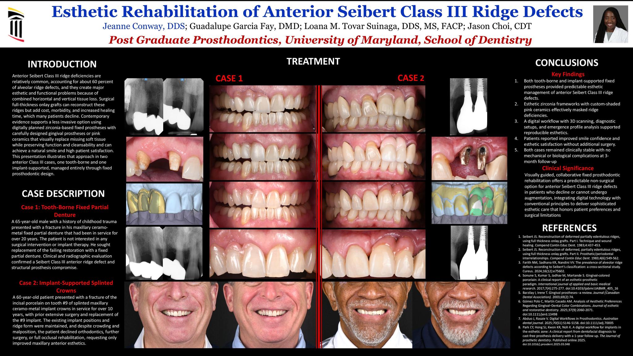 29. Esthetic rehabilitation of anterior Seibert Class III ridge defects